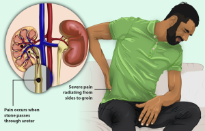 person with kidney stones