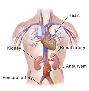 abdominal aortic aneurysm