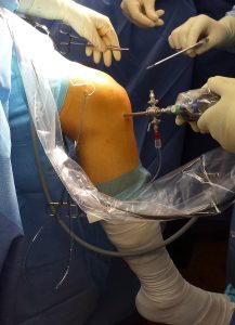 arthroscopy