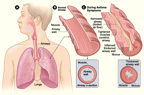 image of what happens to airways during asthma attack