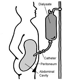 peritoneal dialysis