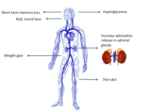 image of symptoms of person with Cushing's syndrome