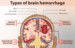 Types of brain hemorrhage