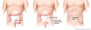 colostomy