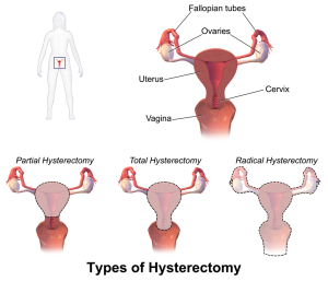 Types of hysterectomy