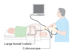 coloscopy