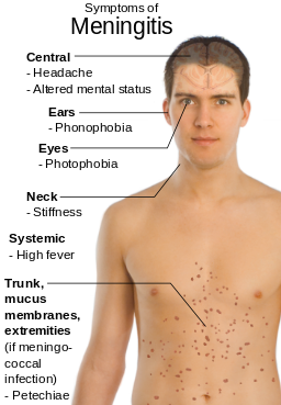 symptoms of Meningitis