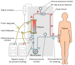 hemodialysis