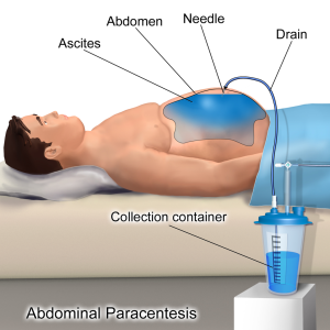 abdominal centesis