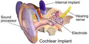 cochlear implant