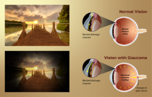 normal vision and person with glaucoma