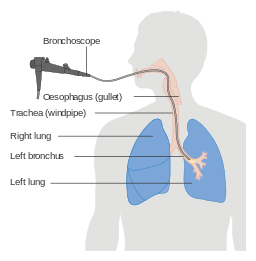 bronchoscopy