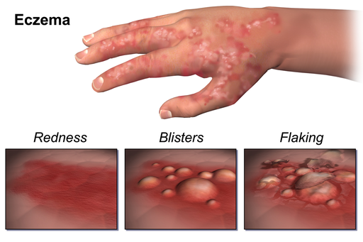 Eczema