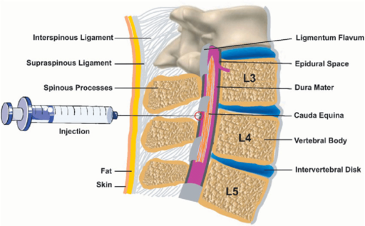 image of an epidural