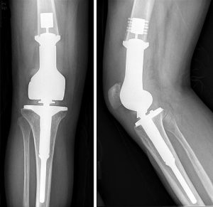 image of arthroplasty