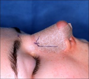 image rhinoplasty