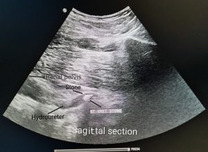 image of Extracorporeal shock wave lithotripsy (ESWL)