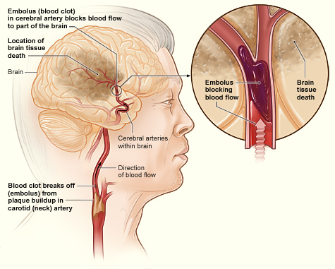 image of a Cerebrovascular accident (CVA)