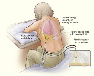 image of thoracentesis