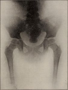 KUB ultrasound (kidneys, ureters and bladder)