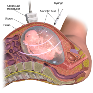 taking a sample of amniotic fluid