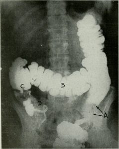 BaE (barium enema)