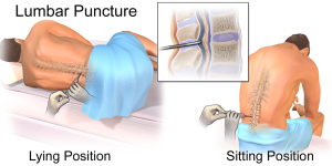 Lumbar puncture (LP)