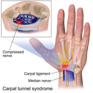 carpal tunnel