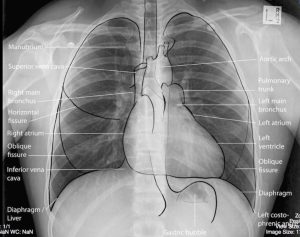 chest x-ray