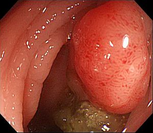 colonic polyp