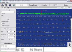 sample of readings from a Holter monitor