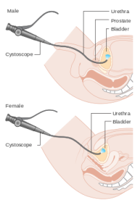 Cystoscopy