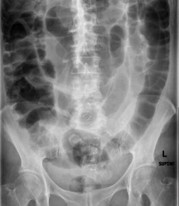 shows generalized bowel dilation