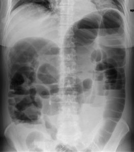 shows generalized bowel dilation