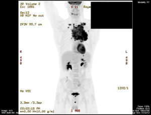 multiple lymphomas PET-CT scan