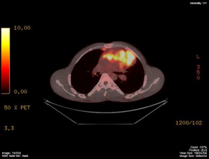 multiple lymphomas PET-CT scan