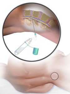 lumbar puncture with a sample of fluid being taken