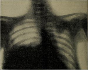 early X-rays taken by Röntgen