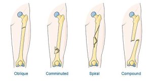 image of different types of fractures