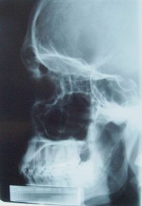 X-ray of a patient with facial trauma