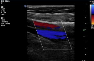 Doppler ultrasound