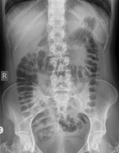 normal abdominal X-rays