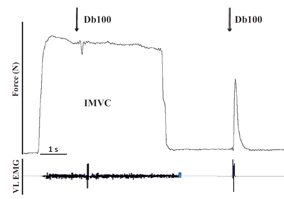 This image shows force for an isometric maximal voluntary contraction lasting about 6 seconds with doublet stimulation at about 2 s. Force rises quickly when voluntary activation is initiated as indicated by the EMG, at the bottom of the figure. A downward arrow indicates application of the stimulation and this is followed by a small upward deflection of the force trace. Immediately after this upward deflection, force dips, because the stimulation impairs voluntary activation. Voluntary activation recovers and force returns to the level immediately before the interpolated contraction. Force drifts downward over the remainder of the time. About 5 s after the end of the voluntary contraction another doublet of stimulation is applied. The resulting force rises quickly then falls. This doublet contraction is much larger than the one superimposed on the voluntary contraction.