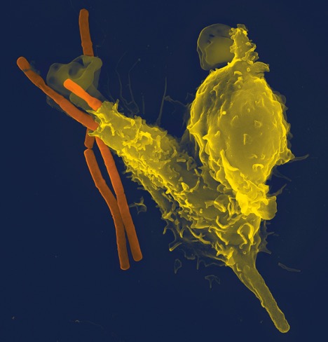 This is a microscopic image of a bright yellow coloured neutrophil, wrapped around an anthrax bacteria (shown as rod-shaped brown stick-like bacteria).