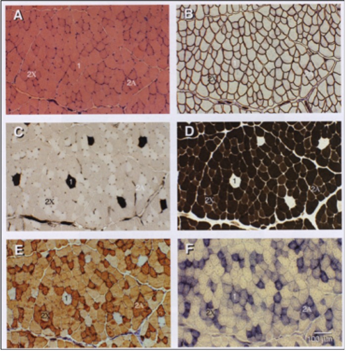 A series of histochemical slides are shown for samples taken sequentially from a muscle biopsy. A illustrates the general structure of the sample: membrane bound cells with thicker bands of connective tissue streaking across the sample. The same bands of connective tissue are evident in each of the tissue slices. B shows dark cell borders where dystrophin is stained. C: of the hundreds of cells in the image, only 6 of them stain darkly, indicating very few type I fibres. D Fast-twitch fibres are stained darkly while the slow-twitch fibres that were dark in the previous slide. E shows staining for myosin ATPase type IIa. Most of the fibres are dark, but the slow fibres identified in C are not, and it is clear that there are two levels of staining in the rest of the fibres.