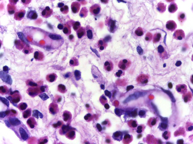 A microscope image of a slice of tissue that has been invaded with eosinophils. The eosinophils, which stain pink have migrated into the tiissue where they will assist with degradation of the tissue.