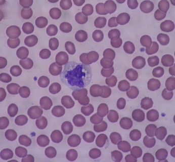 a microscopic image of blood, showing a number of anucleated red cells and one monocyte near the middle. The monocyte has a large purple nucleus.