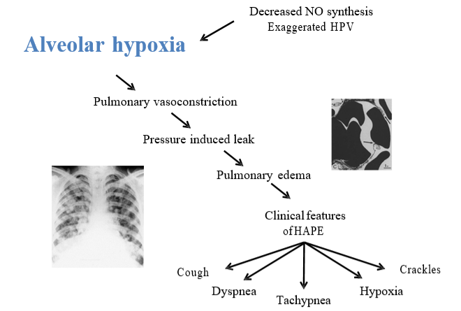 This diagram has two pictures and a sequence of events listed from top left to bottom right. The picture on the left is an x-ray of the lungs, showing scattered dark spots, representing increased density associated with accumulation of fluid (pulmonary edema). The picture on the right shows a microscopic view of a lung with increased space between alveoli. These spaces are occupied by fluid. From top left to bottom right, the sequence of events are: alveolar hypoxia (the primary event triggering these responses), pulmonary vasoconstriction, pressure induced leak, pulmonary edema, clinical features of HAPE: cough, dyspnea, tachypnea, hypoxia and crackles.