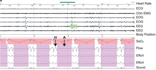 This image shows the results of testing during sleep with frequent episodes of apnea. Of particular interest, air flow stops periodically (purple bands in lower part of the figure), while hyperventilation results in reaction to this lack of breathing. oxygen saturation oscillates, rising with hyperventilation and falling with apnea (note this is offset, due to the time needed for the circulation to reach the sensor). Bursts of activity from the brain re detected with electroencephylography immediately prior to the hyperventilation.