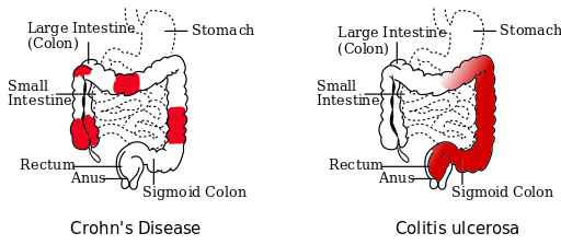 Diagram comparing Crohn's disease and colitis ulcerosa in the intestines. Crohn's disease on the left shows patches of red in the large intestine; Colitis ulcerosa shows a large secion of red extending from the anus to the middle of the large intestine.